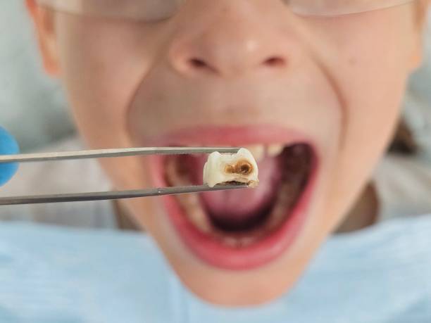 Best Emergency Wisdom Teeth Removal in Kingfisher, OK